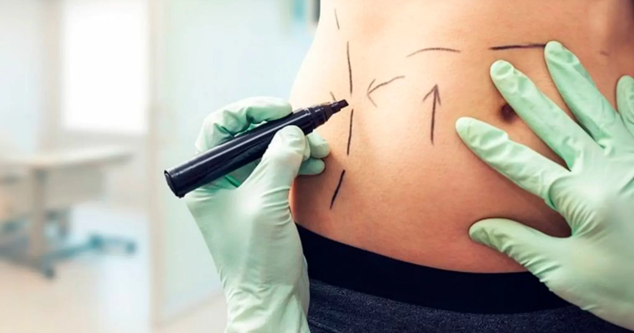 Lipoplastia Nao Aspirativa